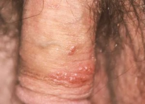 Illustration for article titled Pengobatan penyakit Herpes Simplex